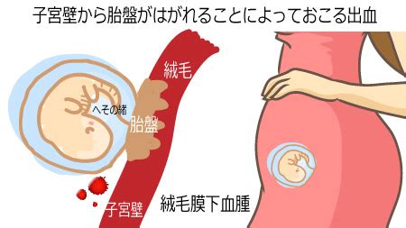 胎盤形成出血|妊娠初期の出血は何が原因？ 心配のない出血と注意。